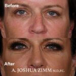 9 Rhinoplasty Before And After