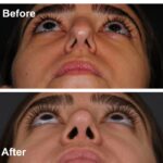 9 Rhinoplasty Before And After 16