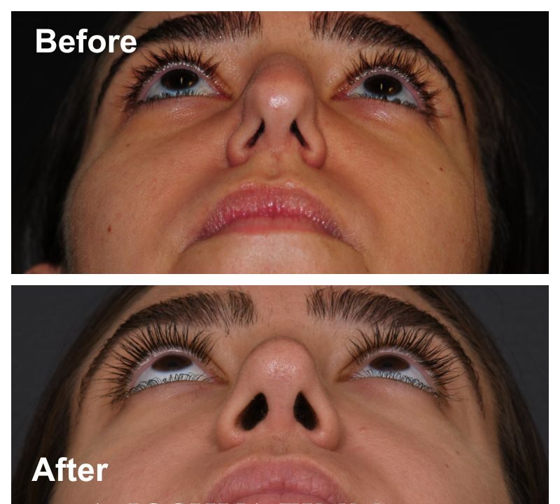 9 Rhinoplasty Before And After 16