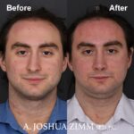 9 Rhinoplasty Before And After 17