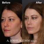 9 Rhinoplasty Before And After 18