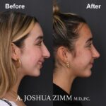 9 Rhinoplasty Before And After 19