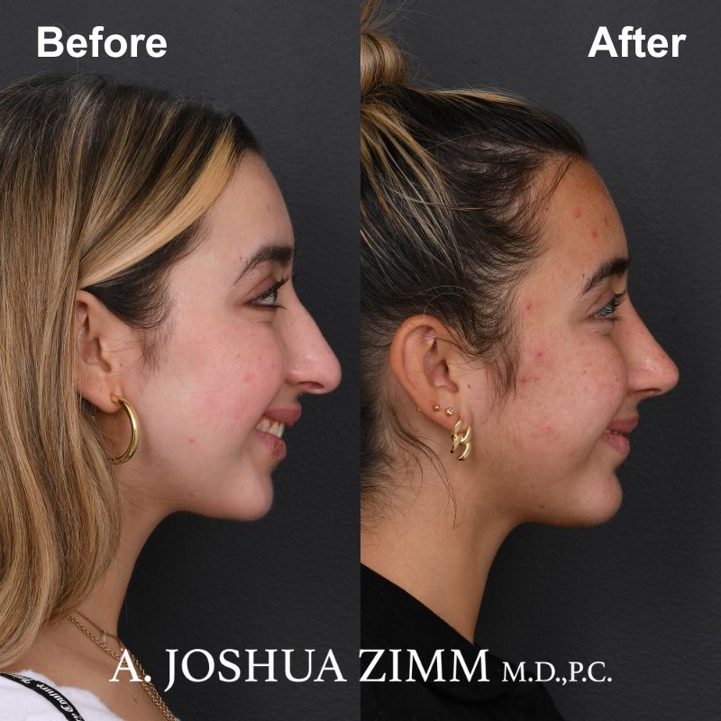 9 Rhinoplasty Before And After 19