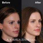 9 Rhinoplasty Before And After 2