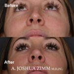 9 Rhinoplasty Before And After 3