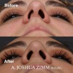 9 Rhinoplasty Before And After 5