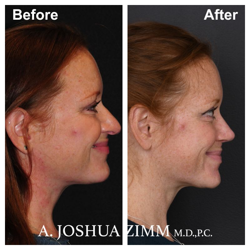 9 Rhinoplasty Before And After 7