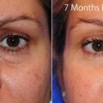 Blepharoplasty2 2