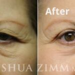 Blepharoplasty20161 1