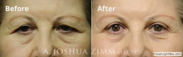 blepharoplasty20161.jpg