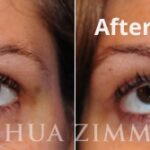 Blepharoplasty201610 2