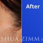 Blepharoplasty201611 1