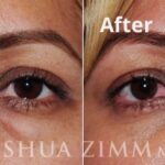 Blepharoplasty201613 1
