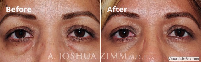 Blepharoplasty201613 1