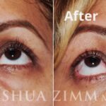 Blepharoplasty201614 1