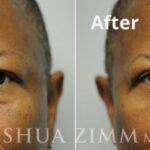 Blepharoplasty20162 1