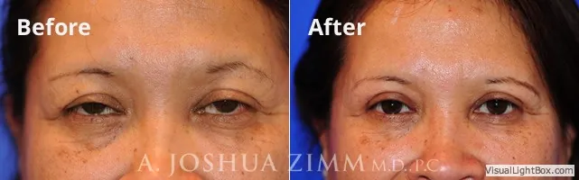 blepharoplasty20163.jpg.webp