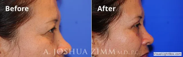 blepharoplasty20164.jpg.webp