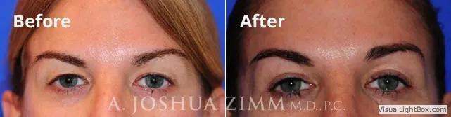 blepharoplasty20165.jpg