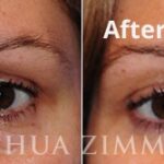 Blepharoplasty20169 2