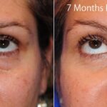 Blepharoplasty3 2