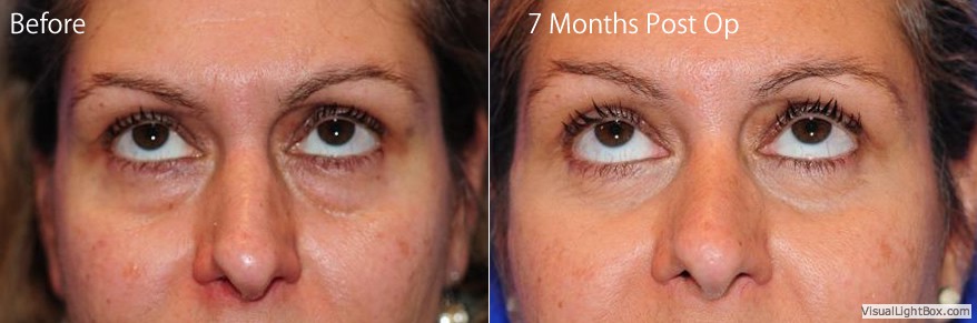 Blepharoplasty3 2