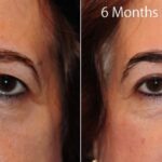 Blepharoplasty4 1 1