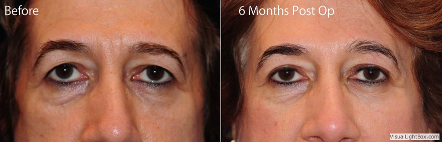 Blepharoplasty4 1 1