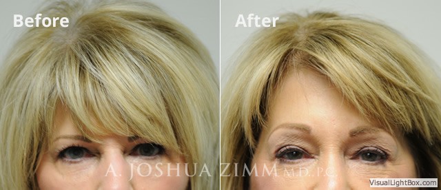 Browlift20161 1