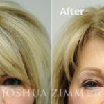 Browlift20161 2