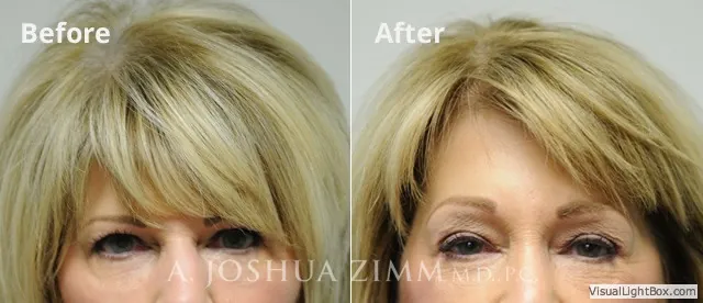 Browlift