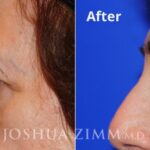 Browlift20162 1