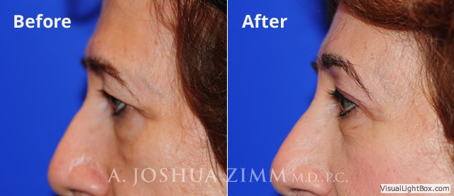 Browlift20162 1