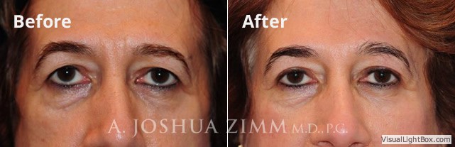Browlift20163 1