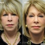 Facelift1