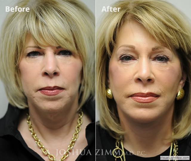 Facelift1