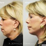 Facelift2