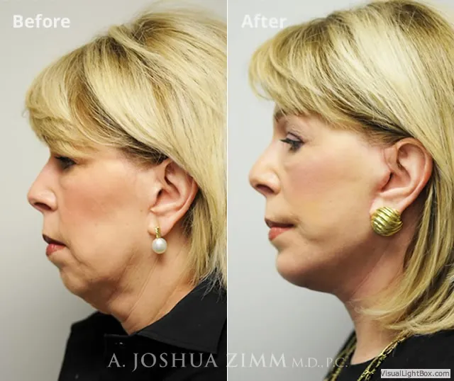 Facelift