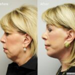 Facelift20161
