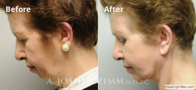 Browlift