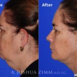 Facelift20181