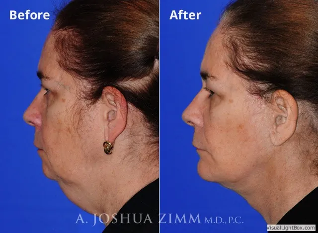 Browlift