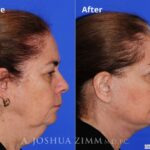 Facelift20182