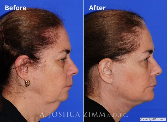 Browlift
