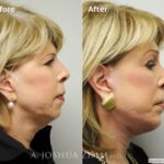 Facelift3
