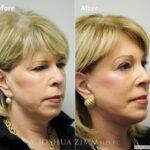Facelift4