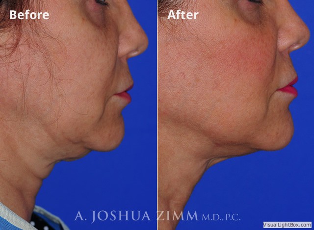 Facetite20185