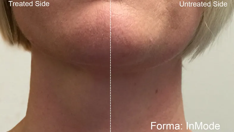 Forma Before After