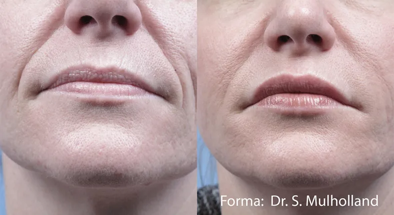 Forma Before After