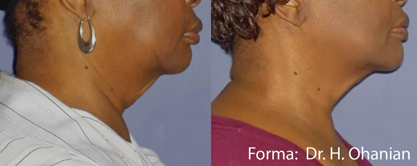 Forma Before After